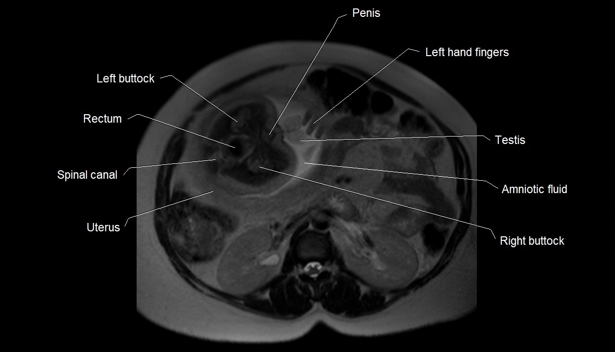MRI fetal anatomy axial image 4.webp